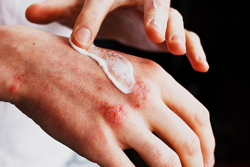 Close-up of a man's hands applying cream to treat eczema, illustrating common skin allergies and treatments
